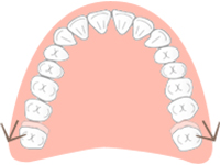 奥歯を移動してスペースをつくる