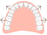 歯列全体を側方に拡げる