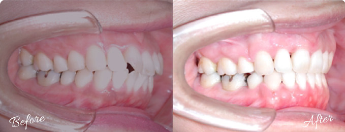 悪い歯並びと症例