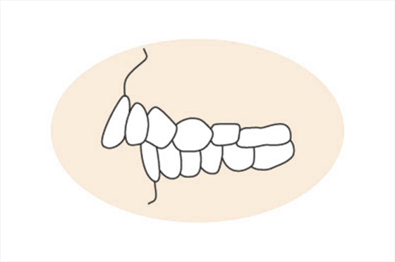 上顎前突（じょうがくぜんとつ）