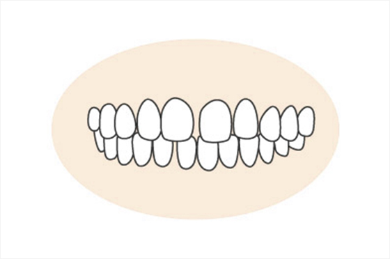 正中離開（せいちゅうりかい）・空隙歯列（くうげきしれつ）