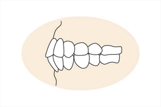 上下顎前突（じょうげがくぜんとつ）