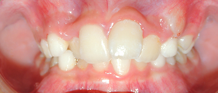 混合歯列抜歯